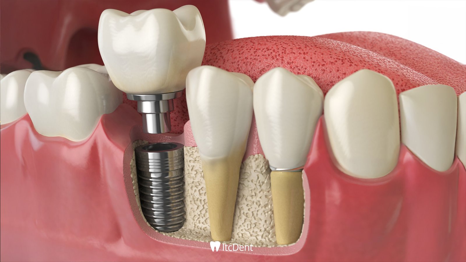 What is Implant Treatment