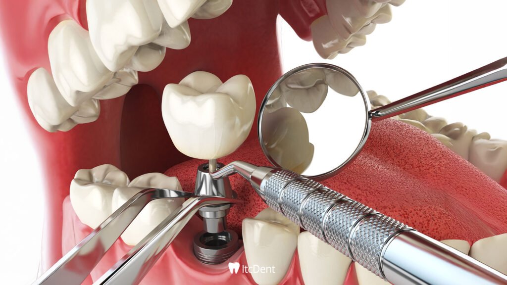 What is Implant Treatment