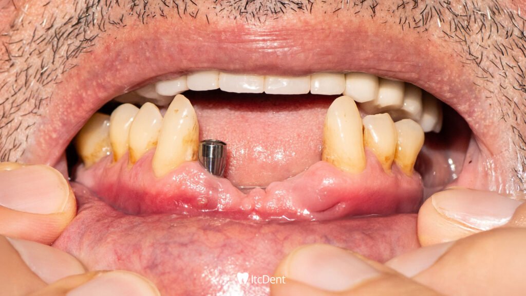 İmplant Tedavisi Nedir