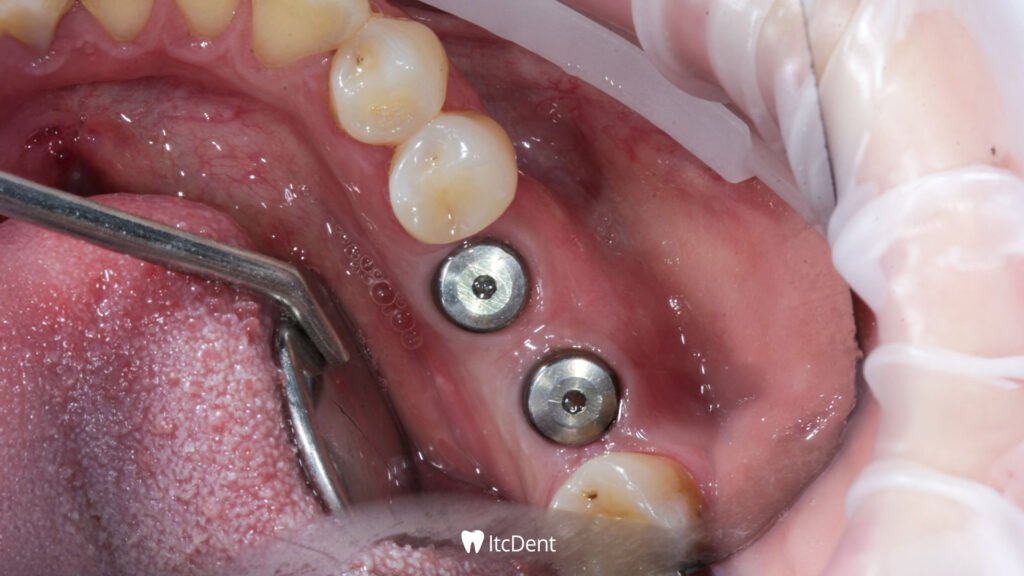 What is Implant Treatment