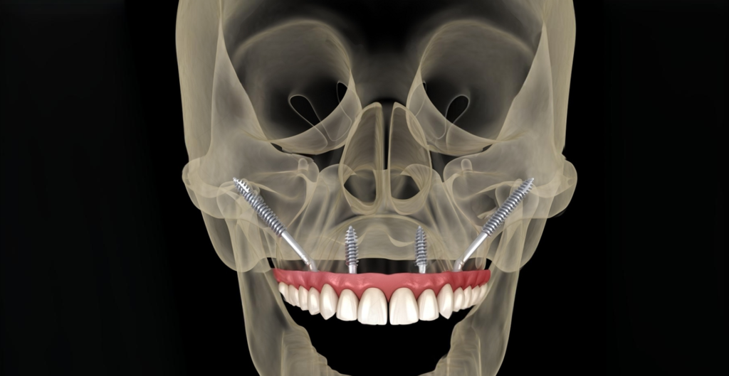 Zygoma Implant