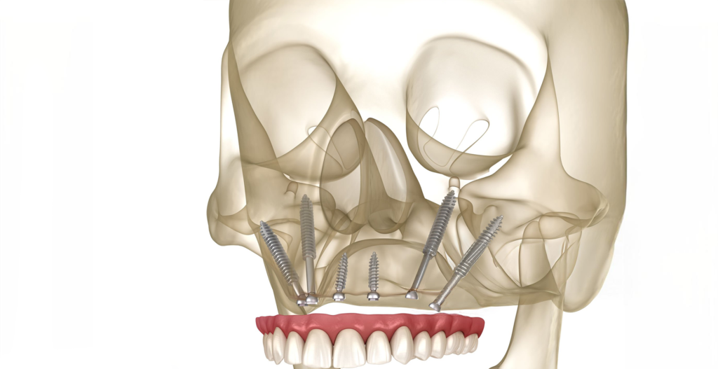 Zygoma Implant