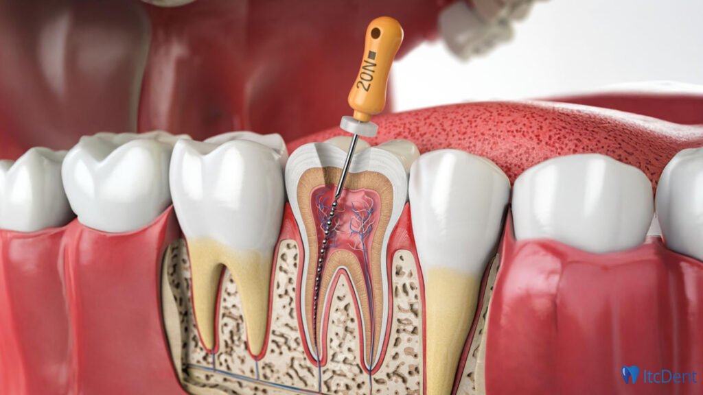 Pain After Root Canal Treatment