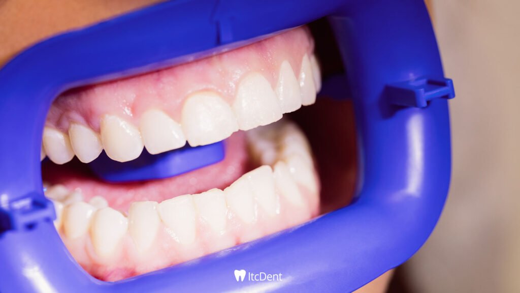 differences between Zirconium and Porcelain Veneers