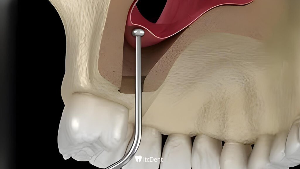 What is Sinus Lift?