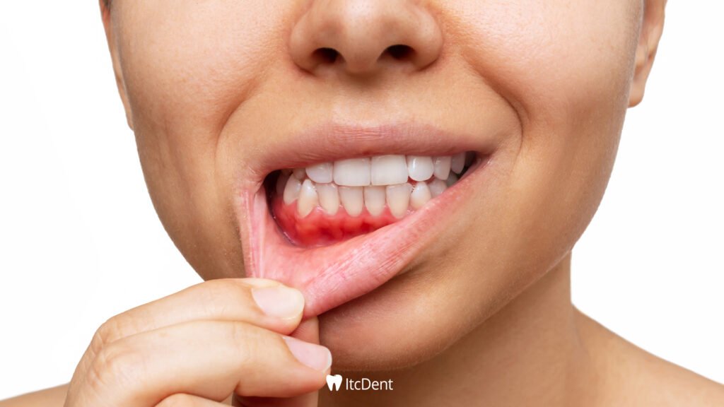 Tooth Abscess