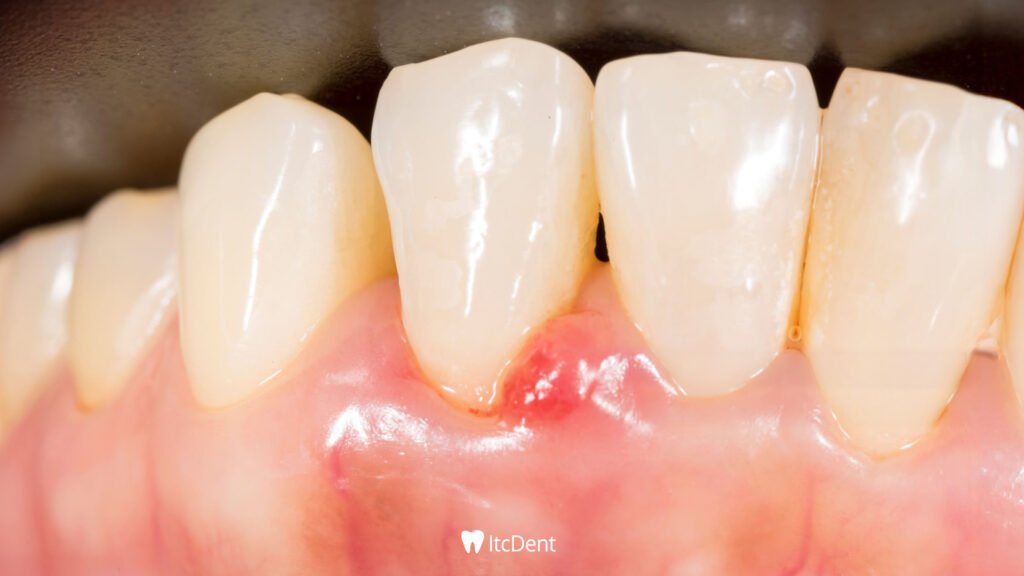 Tooth Abscess