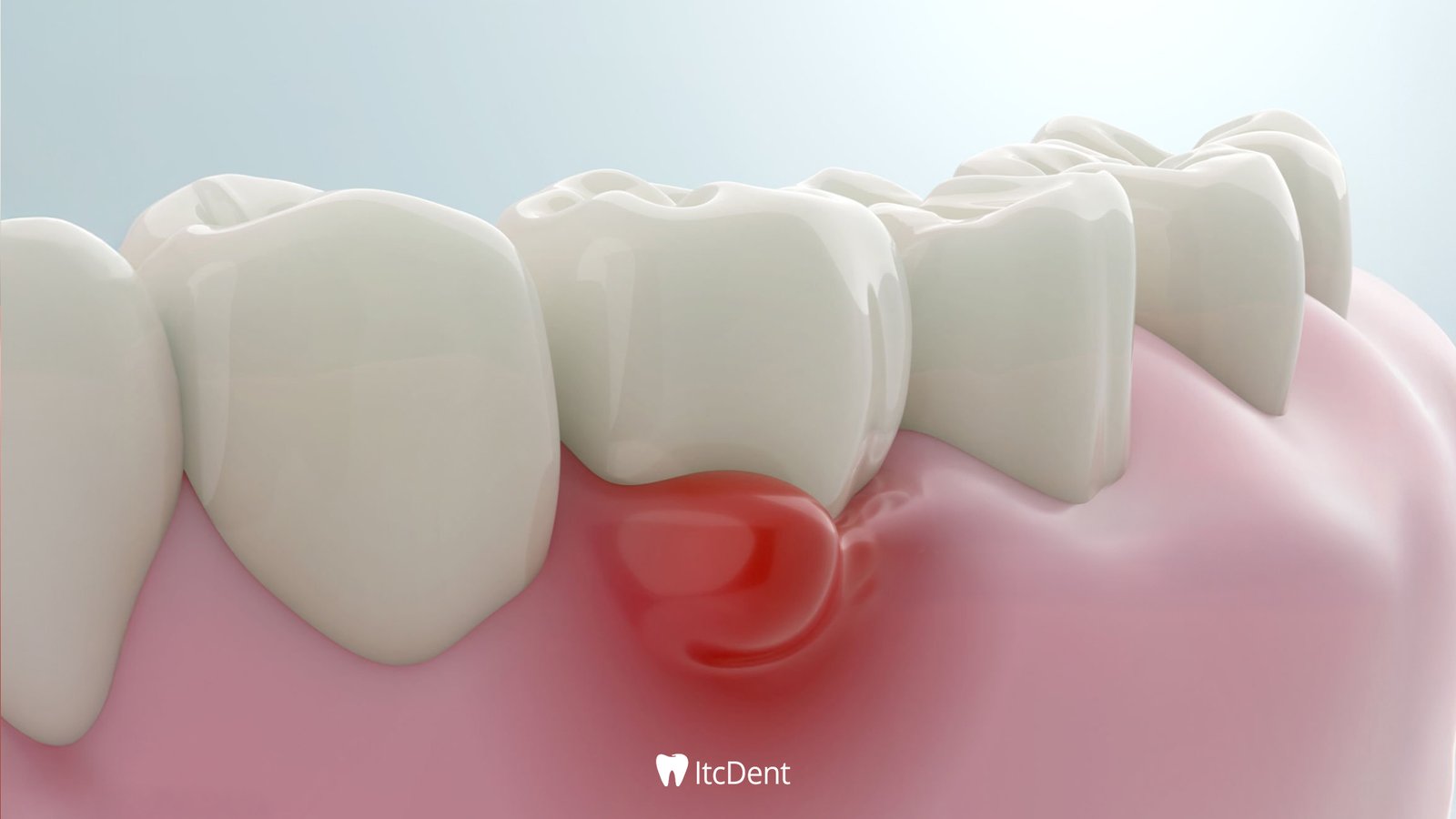 Tooth Abscess