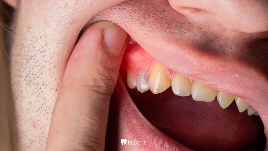 Tooth Abscess
