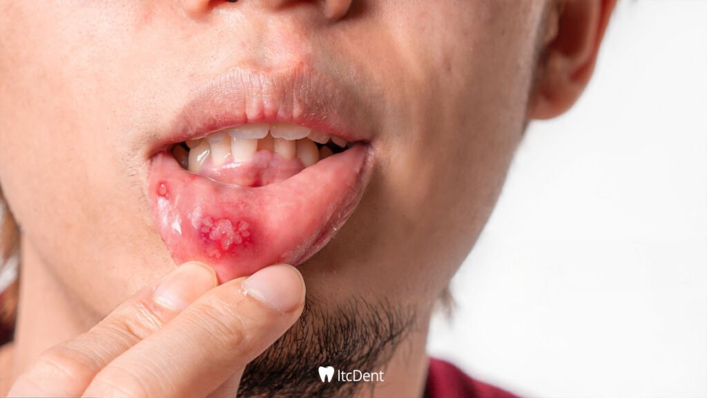 How to Get Rid of Mouth Sores