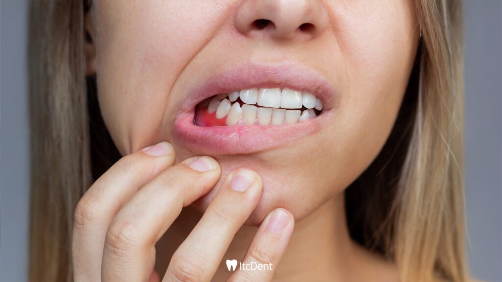 How to Get Rid of Mouth Sores