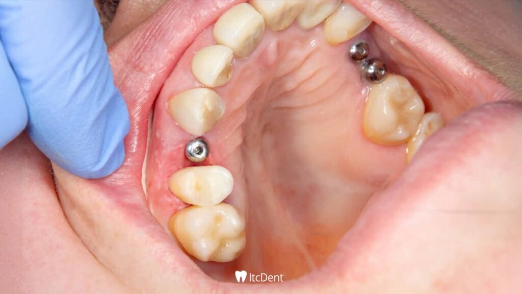 Seamless Implant