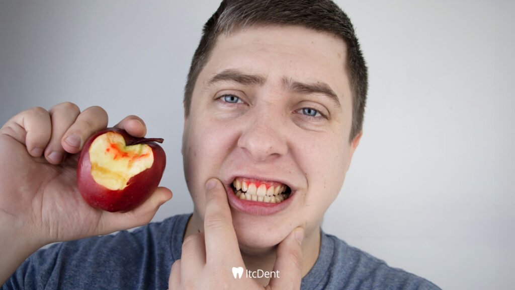 Bleeding Gums
