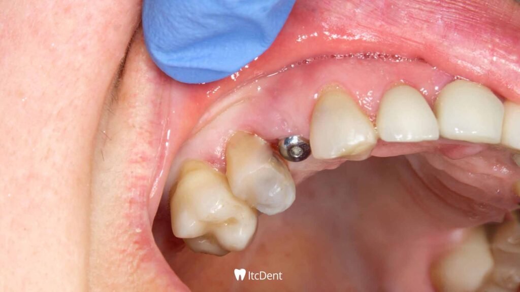 Seamless Implant