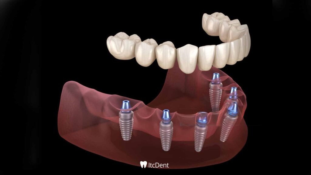 Seamless Implant