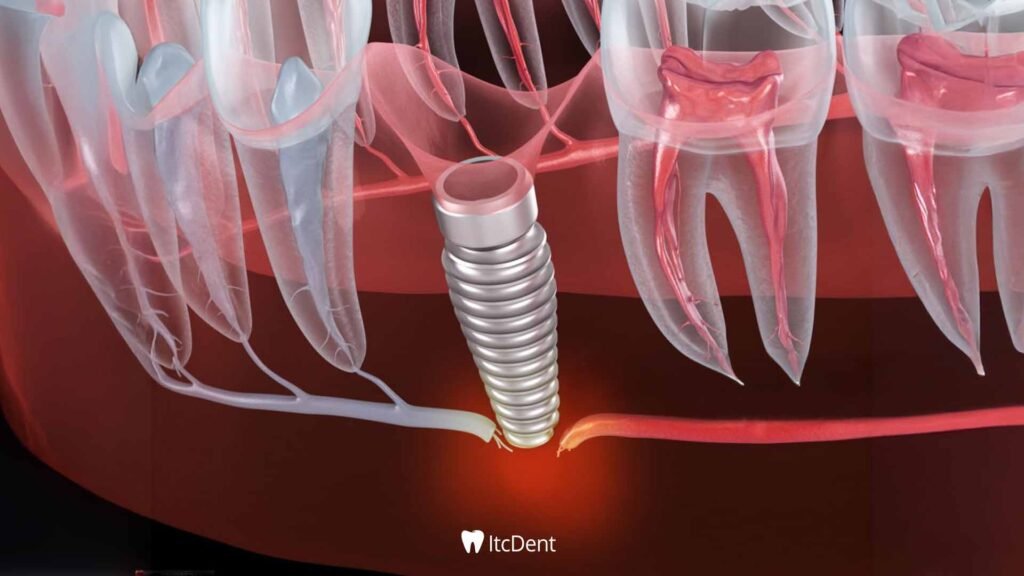 Seamless Implant