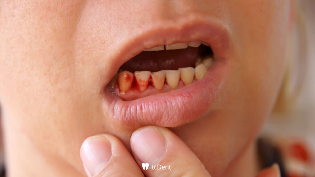 Bleeding Gums