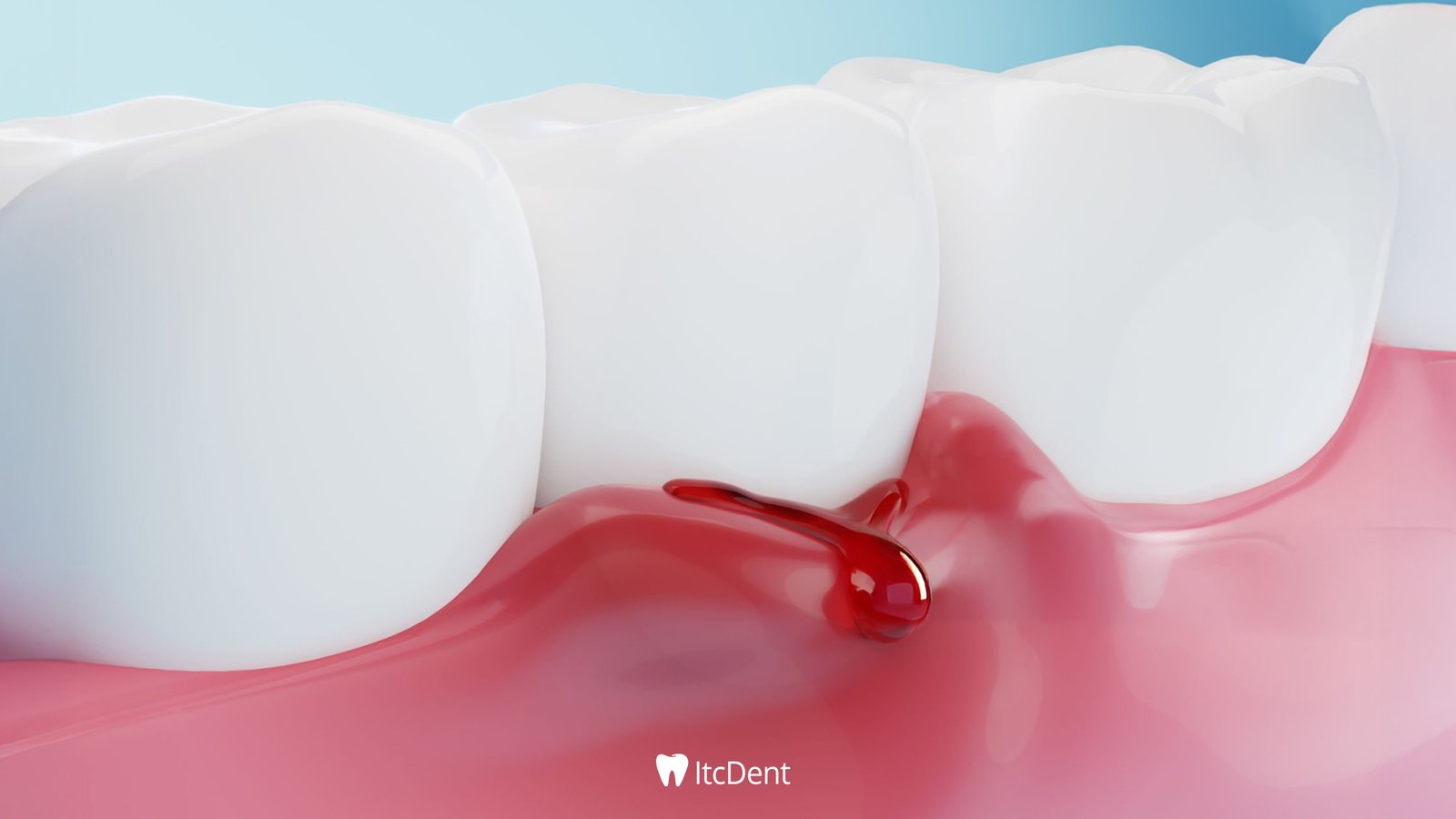 Bleeding Gums