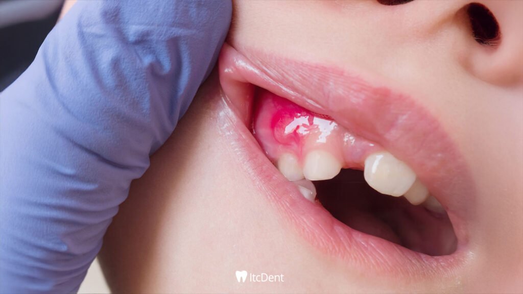 Dental Inflammation