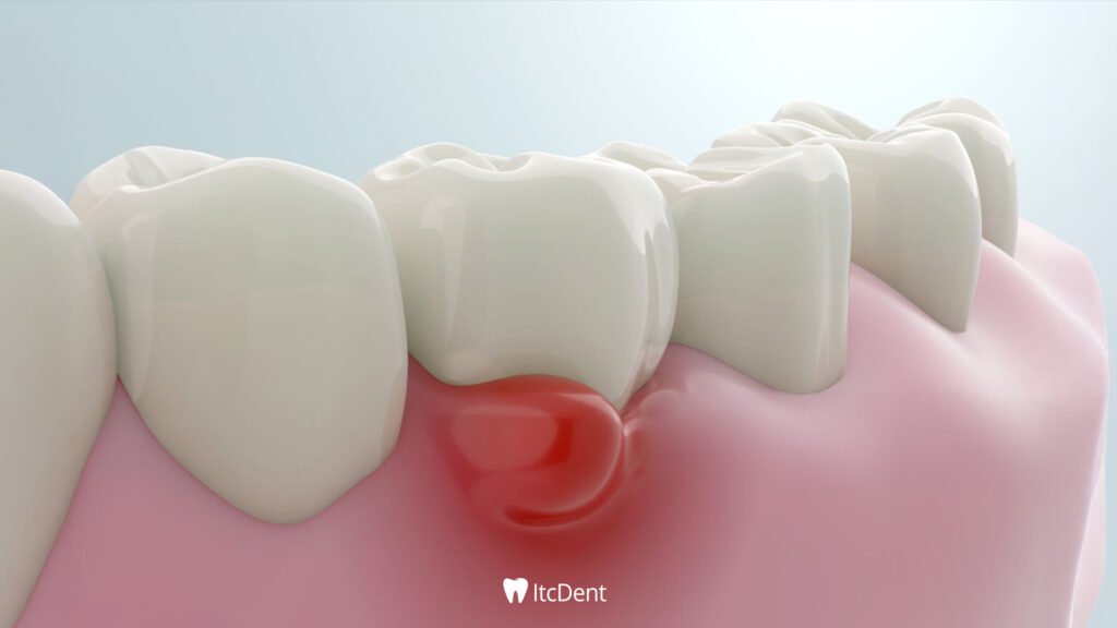 Dental Inflammation