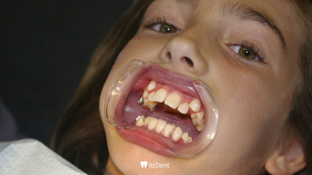 Crooked Teeth