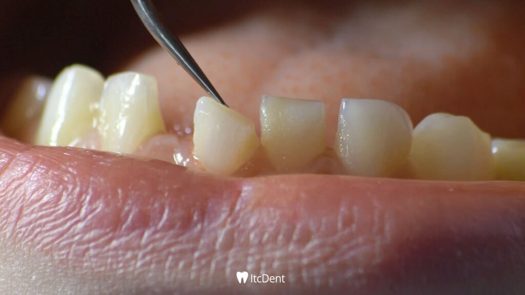 Crooked Teeth