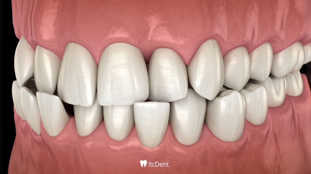 Crooked Teeth