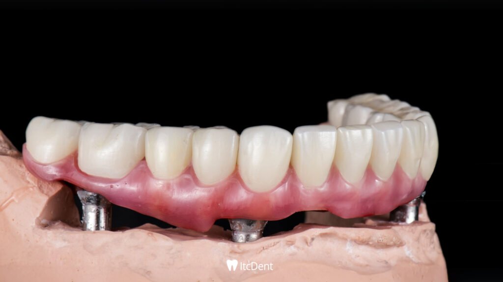 Implant Supported Prosthesis