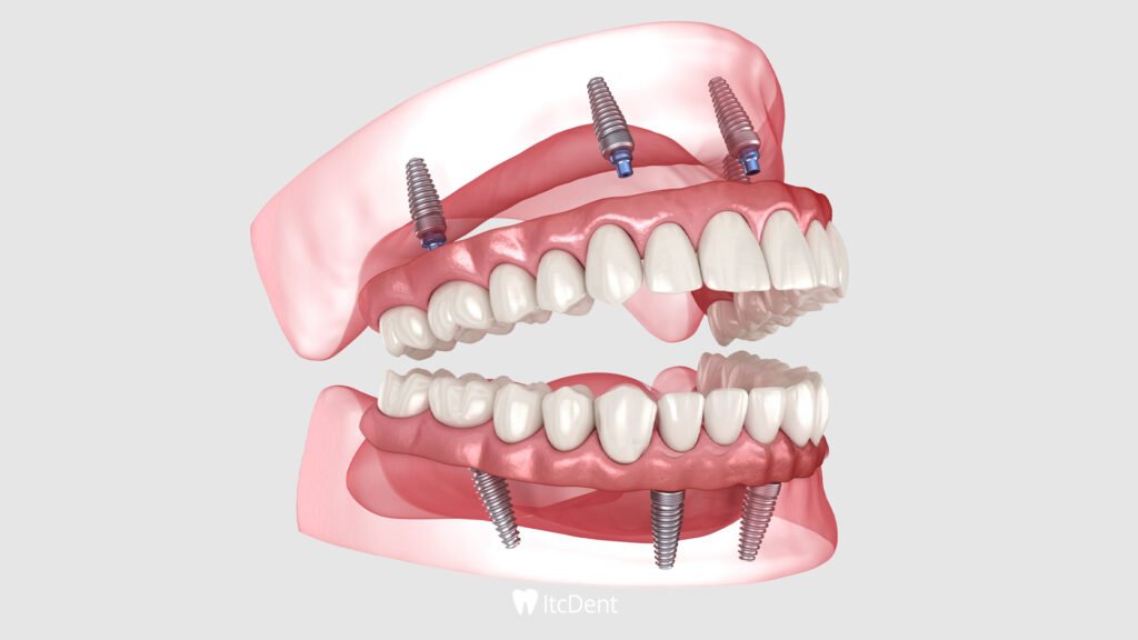 Implant Supported Prosthesis