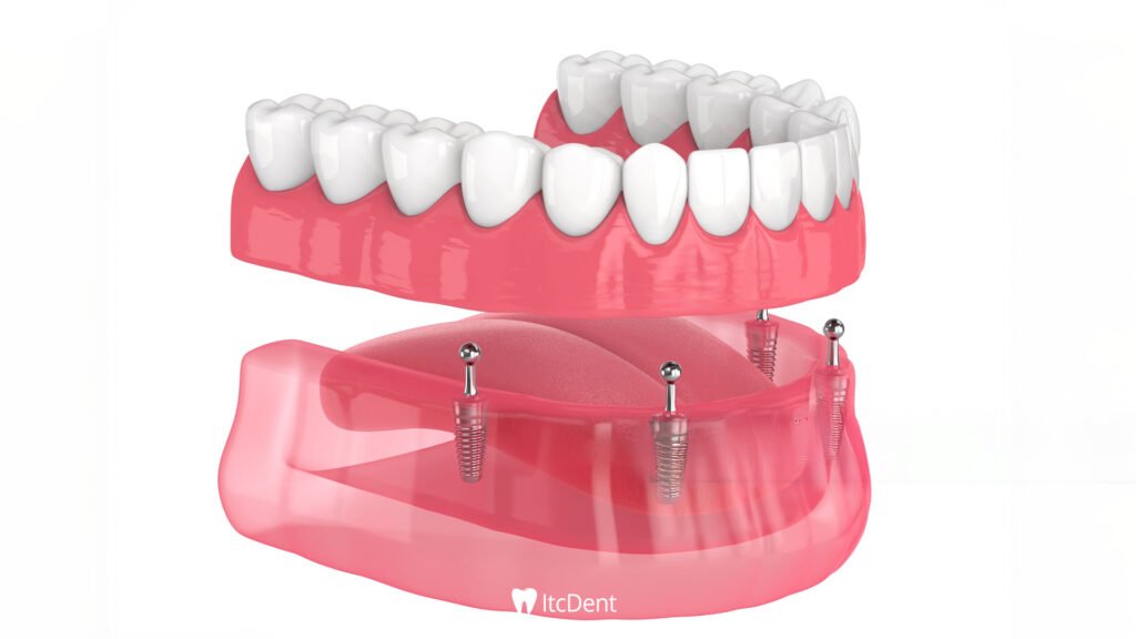 Implant Supported Prosthesis