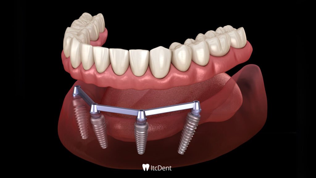 Implant Supported Prosthesis