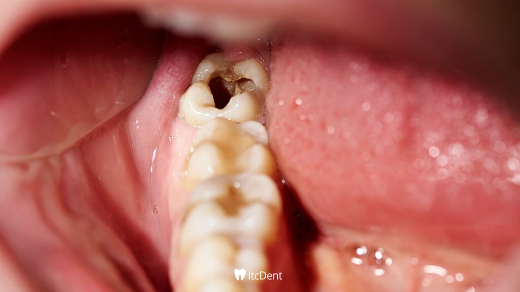 Decayed Toothache Treatment