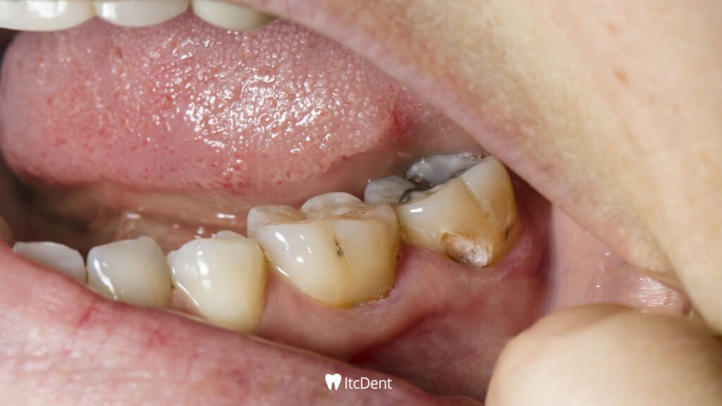 Decayed Toothache Treatment