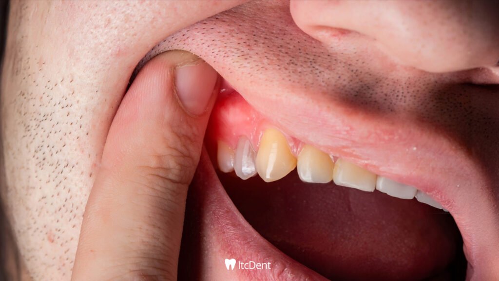 Gum Inflammation