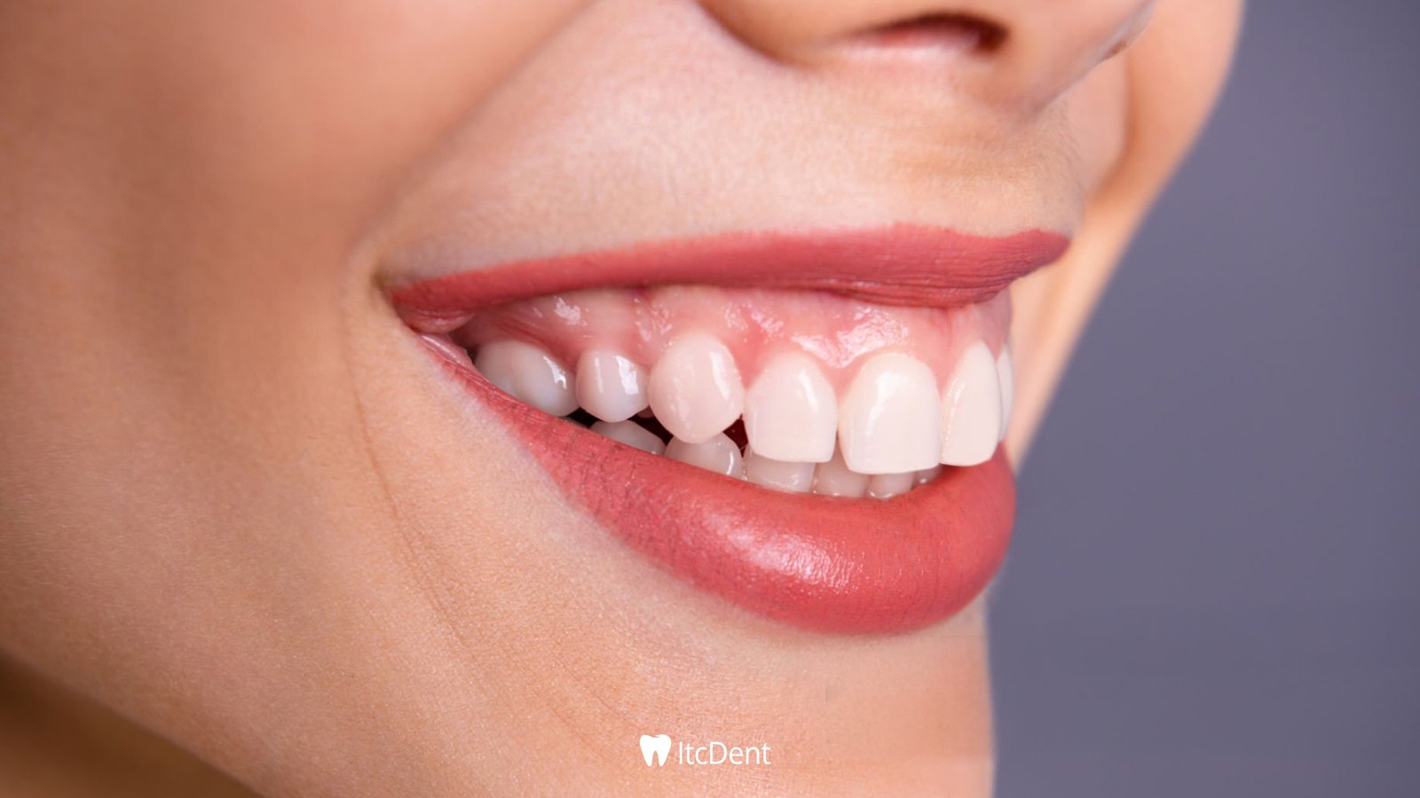 What is a Gummy Smile?