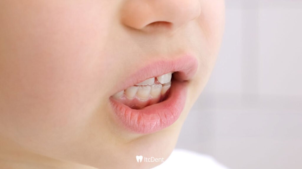 What is Malocclusion?