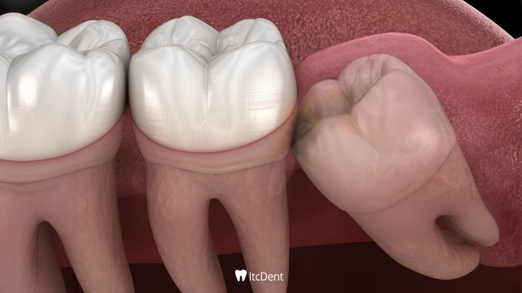 Impacted Tooth Extraction