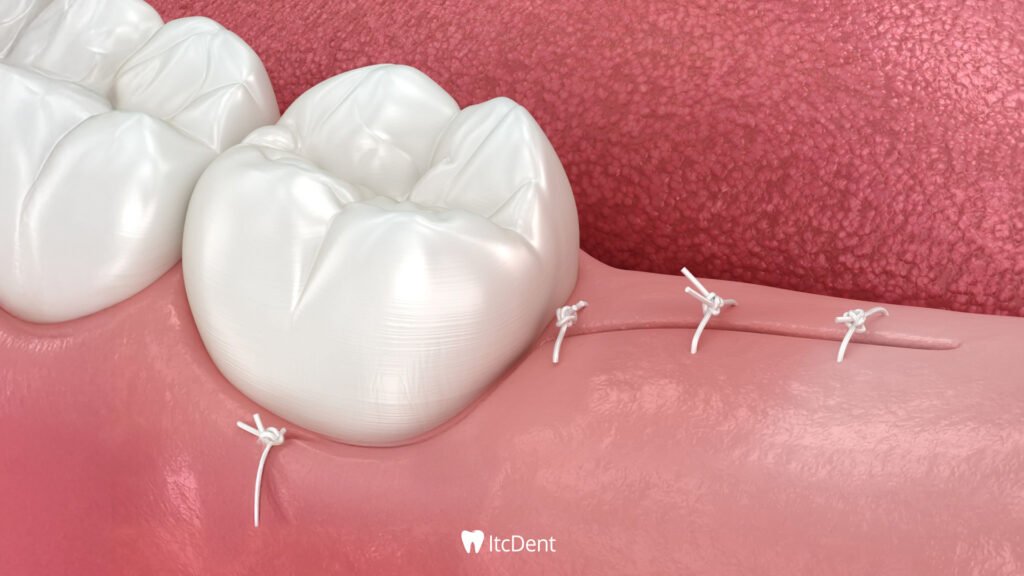 Impacted Tooth Extraction