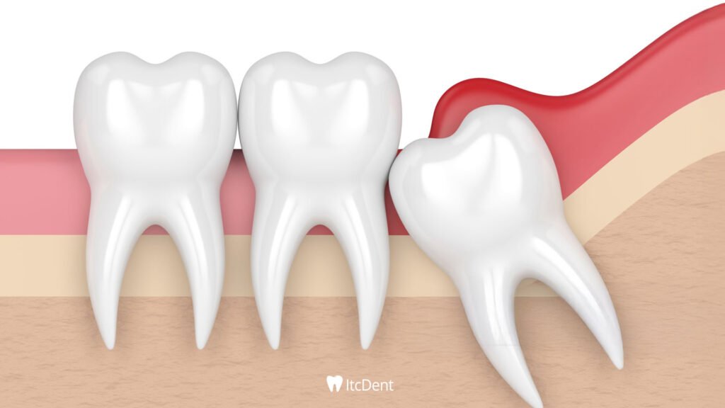 Impacted Tooth Extraction