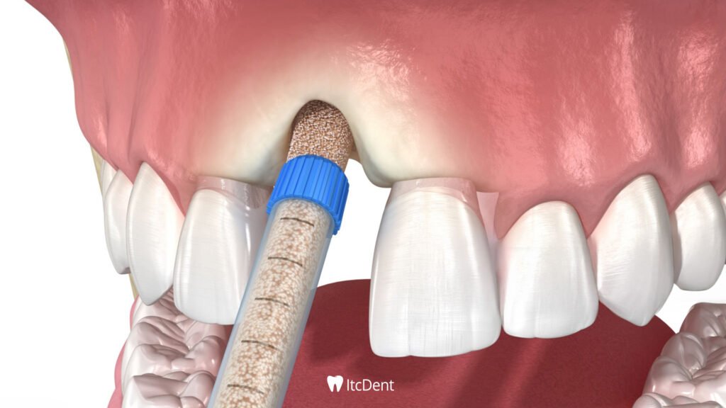 What is Bone Graft