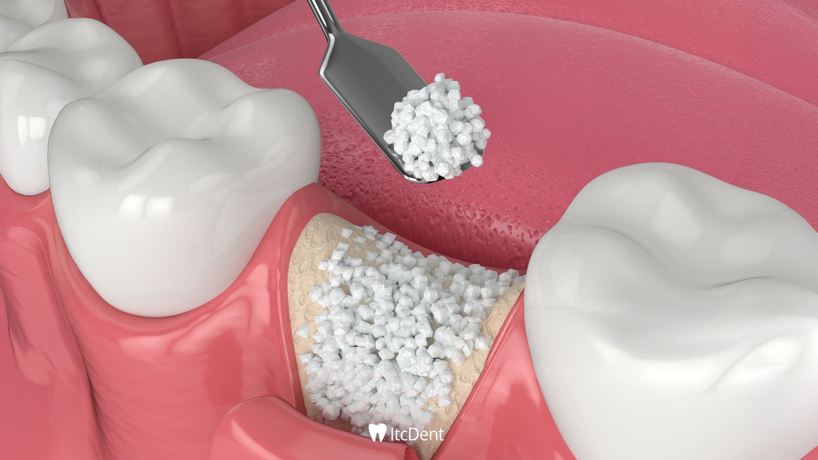 What is Bone Graft