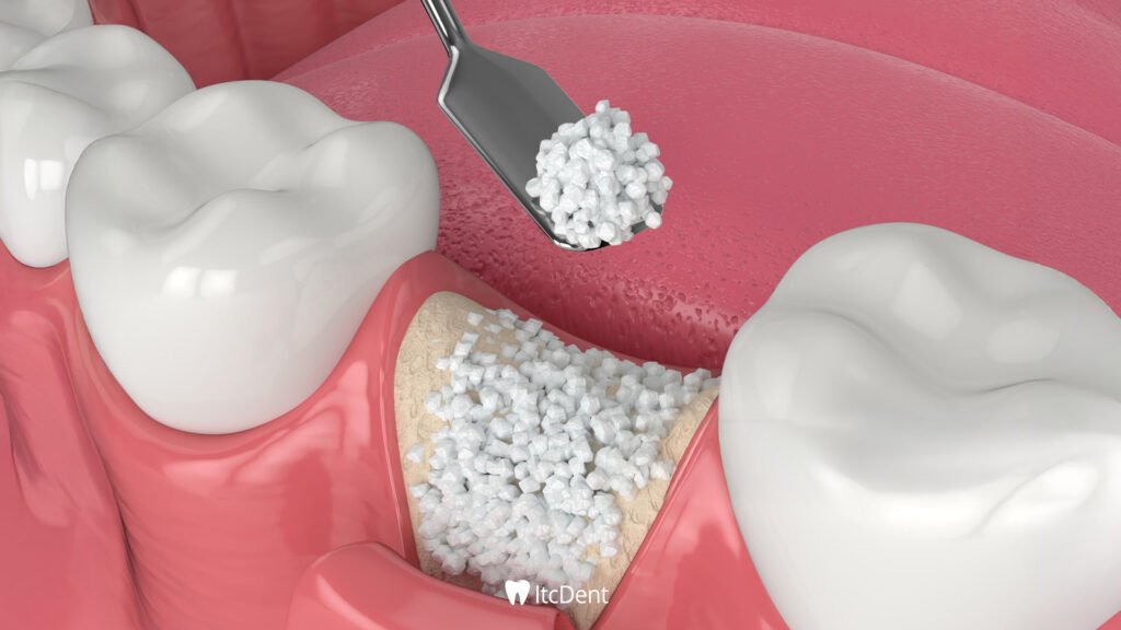 What is Bone Graft?