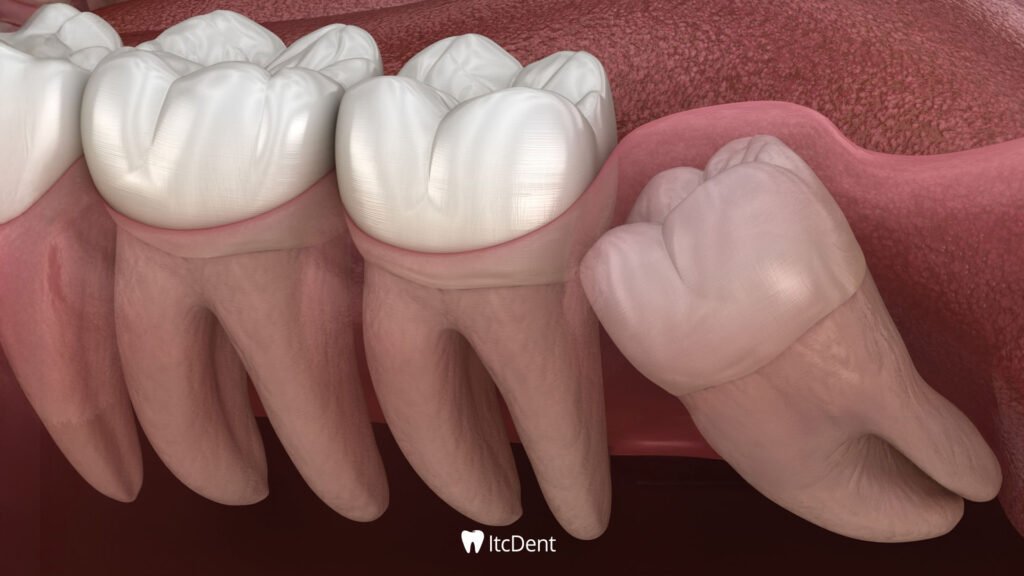 What is a Wisdom Tooth