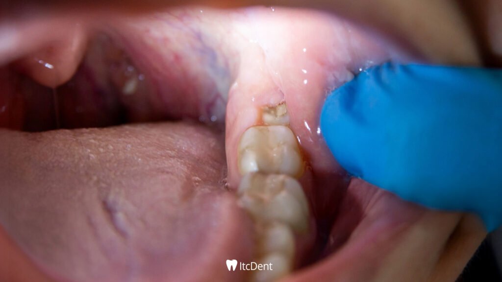 What is a Wisdom Tooth