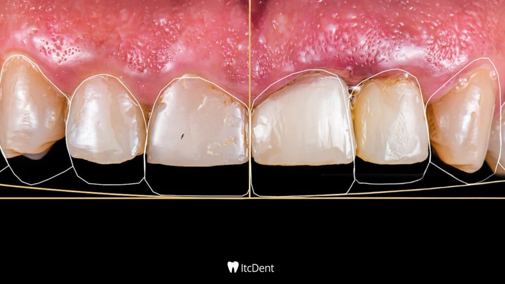 What Is Digital Smile Design?
