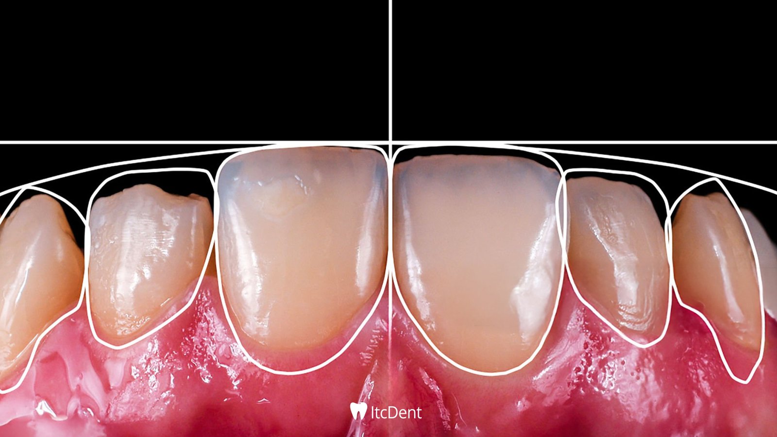 What Is Digital Smile Design?