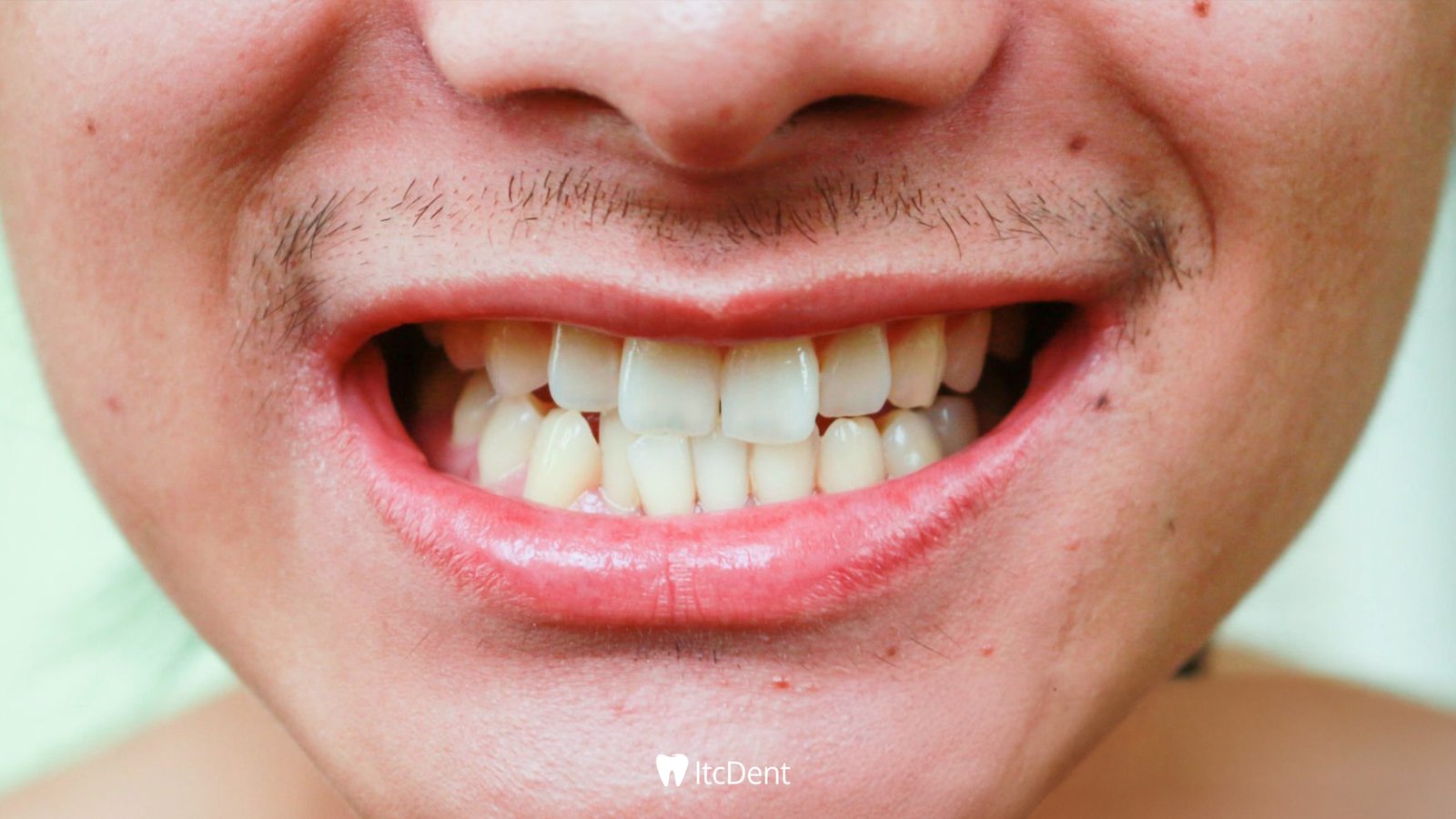 What Is Teeth Clenching (Bruxism)?