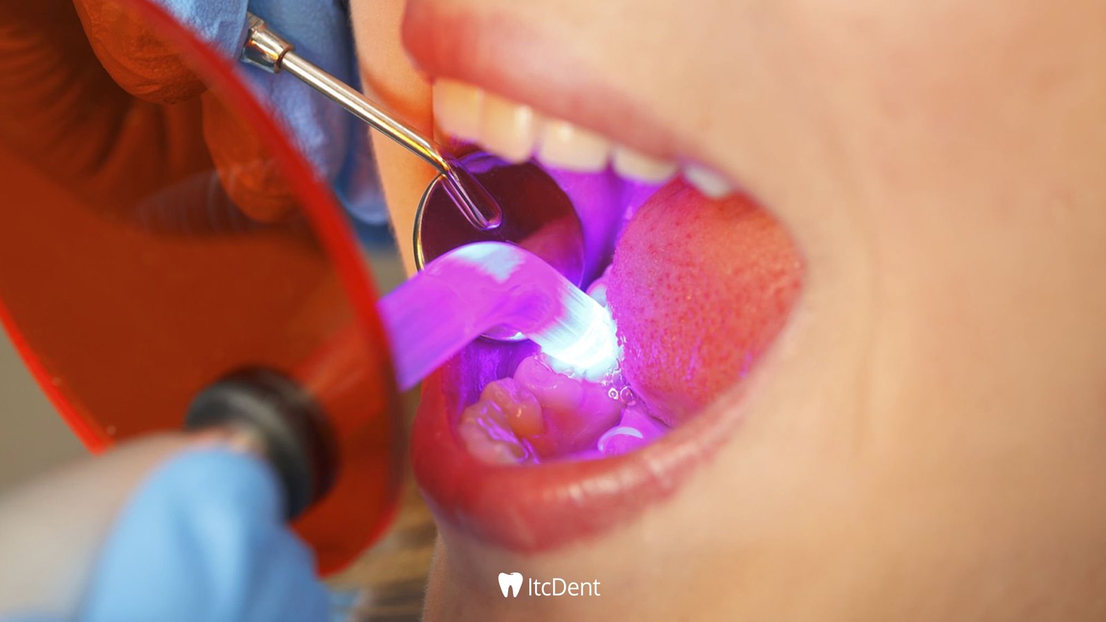 What is a Composite Filling?