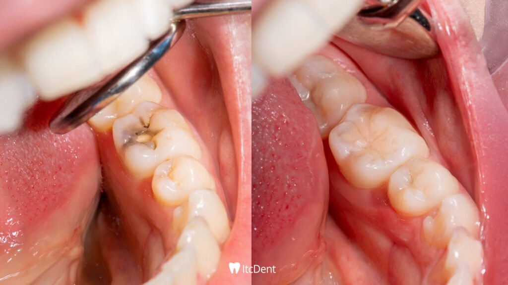 What is a Composite Filling?