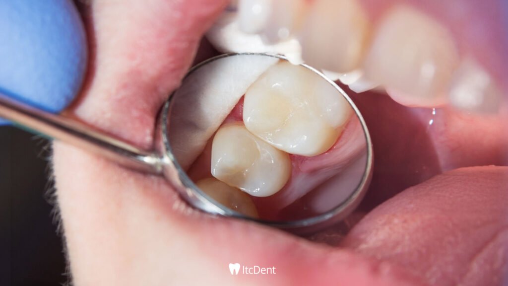 What is a Composite Filling?